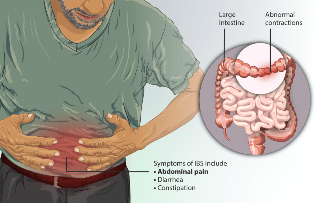 Healing Irritable Bowel Syndrome (IBS): A Root Cause Approach - Hormone Reset