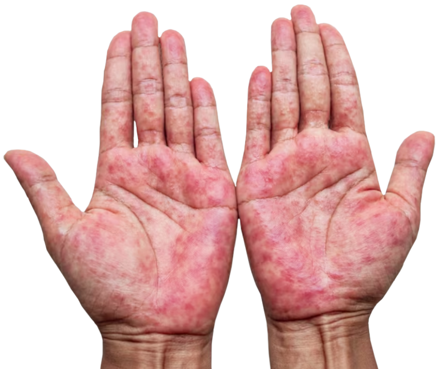 What is Psoriasis Disease 8 pd 3