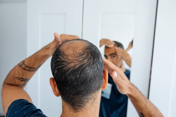 Alopecia