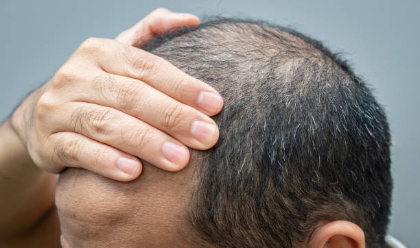 Alopecia