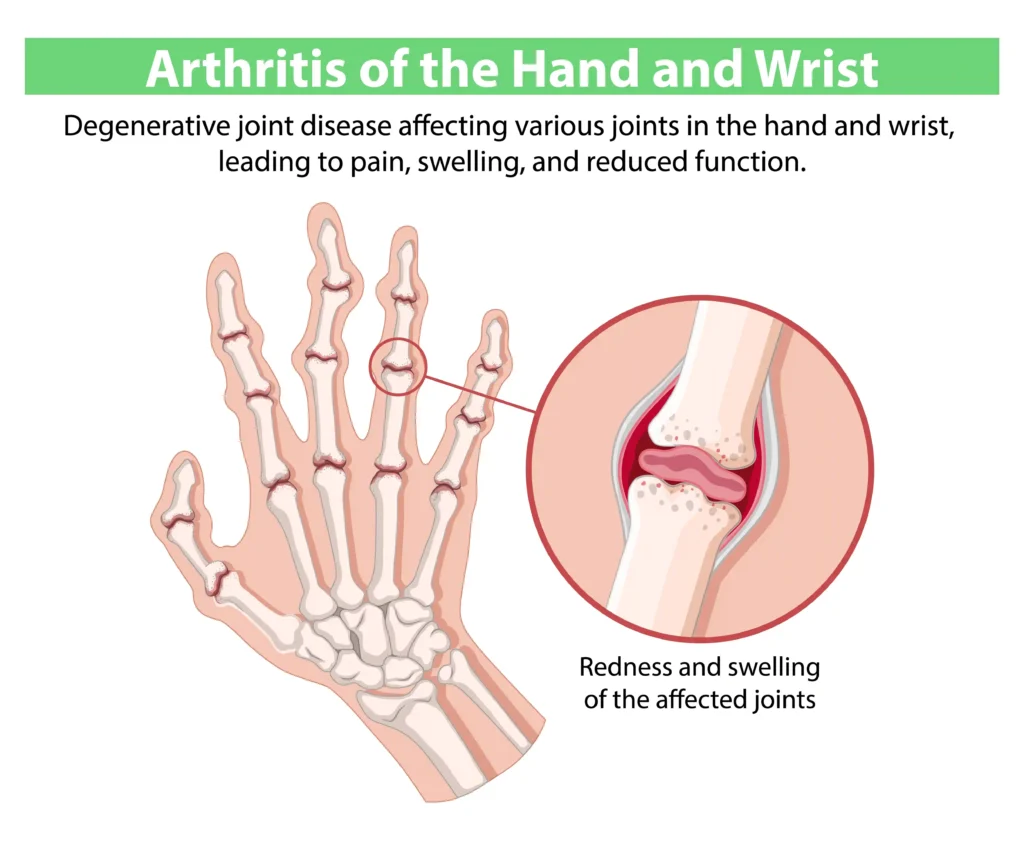Understanding Rheumatoid Arthritis